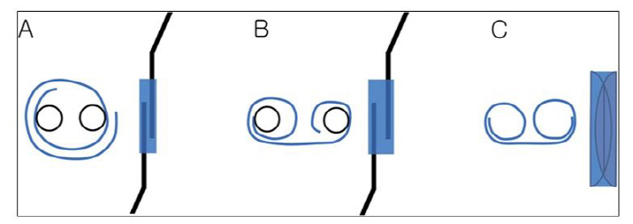 New Corneal Endothelial Cell Transplantation Improves Success Rate and Stability