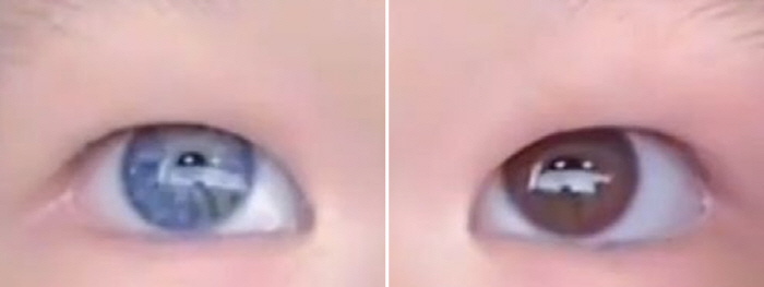 Seven-year-old girl's eyes are different in black and blue...What kind of disease is it?