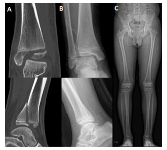 Children's ankle growth plate fracture reduces treatment burden with bioabsorbent screws