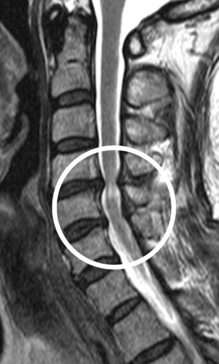 Development of AI to predict the prognosis of cervical spinal cord surgery...94% accuracy