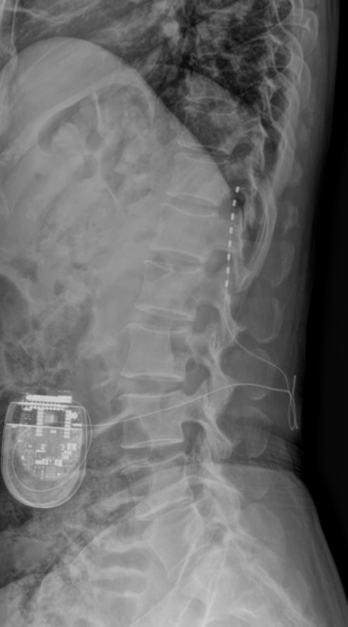 Easing pain with electrical stimulation...Effective alternative to spinal nerve stimulation for intractable pain