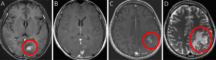 I thought it was a brain tumor, but a rare parasite infection...Announcement of Cases of Inflammatory Lesions Treatment