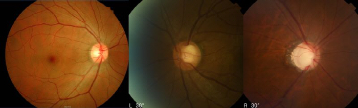 Glaucoma Increase in Young People's Blind Diseases...associated with an increase in highly myopic patients