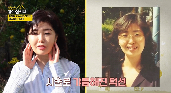 Hong Hye-gul ♥ Yeo Esther, her face changed after braces..Before and after cheekbones are in, too. 