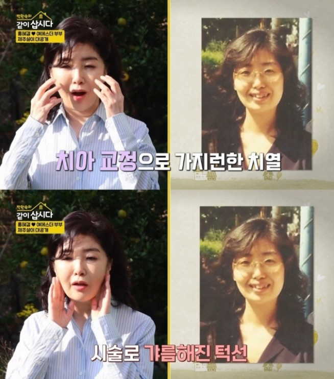 Hong Hye-gul ♥ Yeo Esther, who explained the suspicion of plastic surgery, put a syringe instead of a knife, braces in their 50s (Let's live together) 