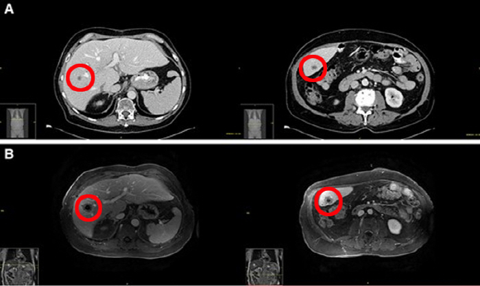 Cancer Reoccurrence After Liver Transplantation...derived from cancer cells in donor liver