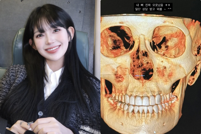 91 → 47 kg, Choi Jun-hee who fixed her eyes and nose, eventually got counseling for bilateral surgery..♥ A desire for plastic surgery that even my boyfriend can't stop