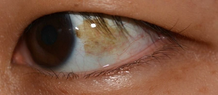 Mucosal nevus in the eye, must I remove it?