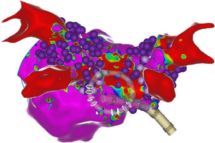 Seoul National University Hospital succeeded in treating atrial fibrillation with Korea's first three-dimensional pulsed bowel resection