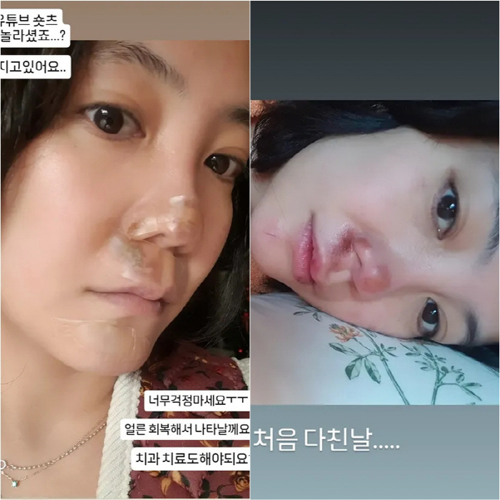  Nose surgery, I paid for a medium-sized car...Go Eun-ah, a large nose injury on the ice → Should I have surgery again