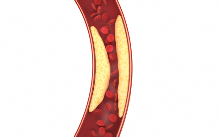 Chest tightness pain during exercise, suspected coronary hematoma...If left unattended, it's life threatening