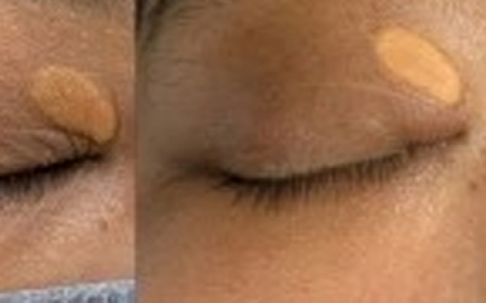 ErYAG Laser Finds Effectiveness in Treatment of Eyeloma...Less pain, faster recovery time