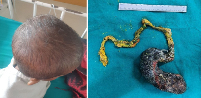 A 4-year-old girl found a lump of rat-shaped hair in her stomach...What kind of disease is it?