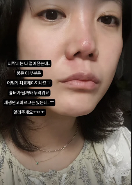 Goeun, I'm afraid I'll get scars on my nose that cost me a medium-sized car