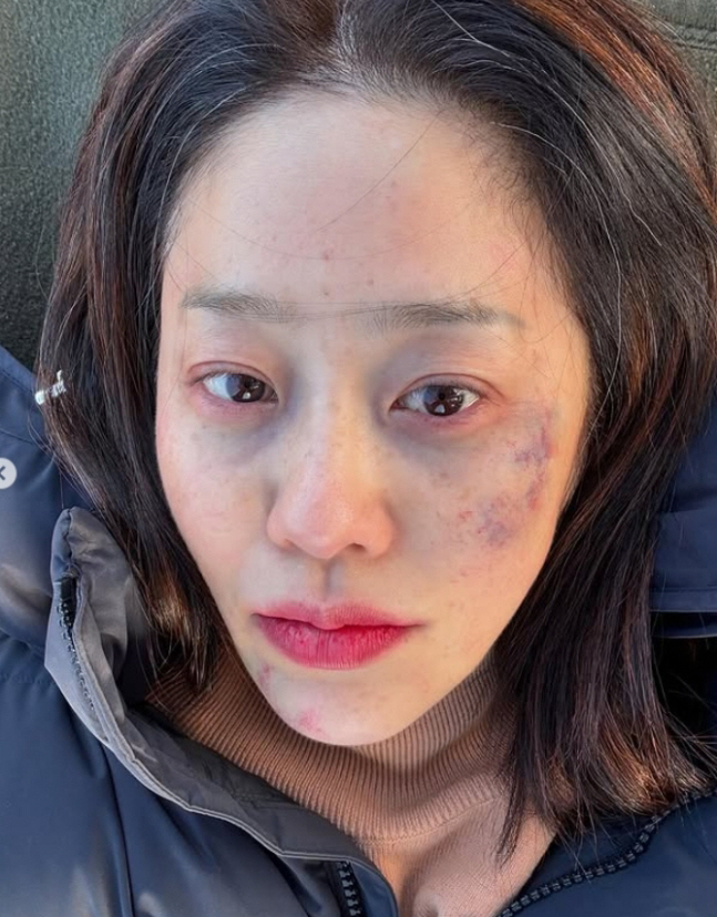  Ko Hyunjung with white hair  bruises, what's going on? I want to sleep in