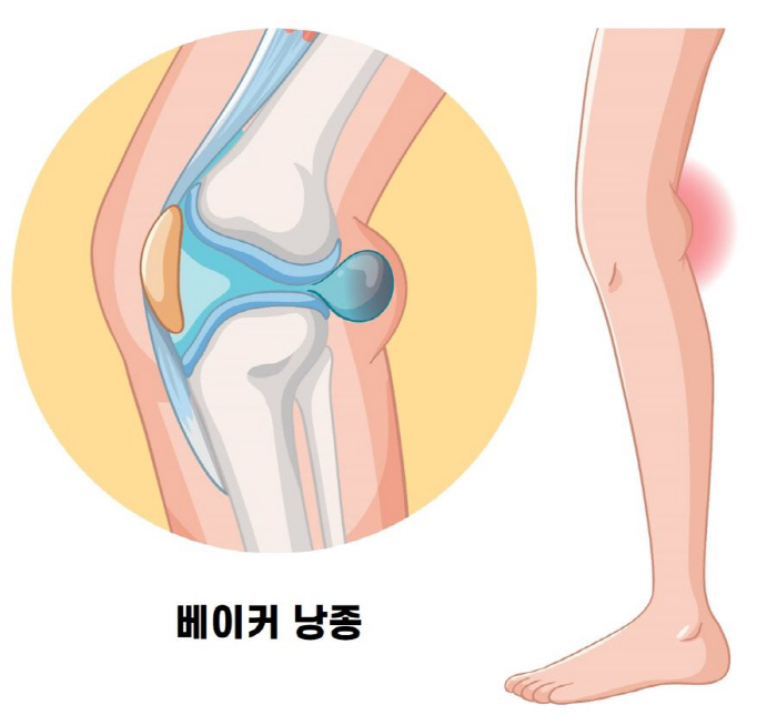 A poultice baker cyst in the back of the knee, what kind of disease is it?