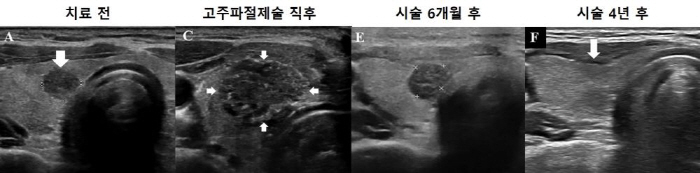 Microthyroid papillary cancer, confirming the effectiveness and safety of radiofrequency ablation...96% of patients are missing tumors