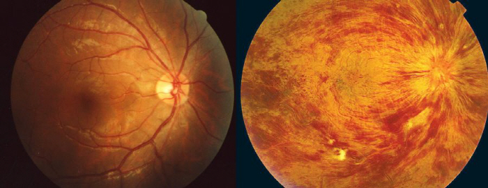 What if one eye suddenly becomes blurred? Suspected retinal vascular obstruction causing blindness