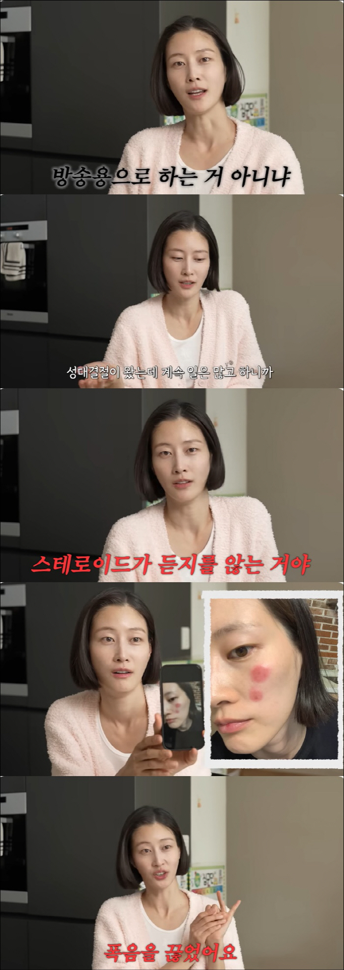 Lee Hyun-yi doesn't listen to steroids to confess to health after a rare incurable disease