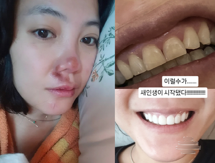 Go Eun-ah, your face has changed significantly after treating a serious injuryStart a new life